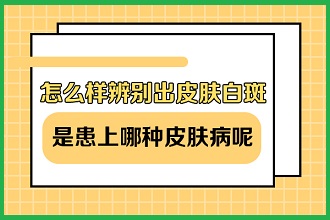 白癩風患者運動改善體質，同時這些事項注意不能缺少